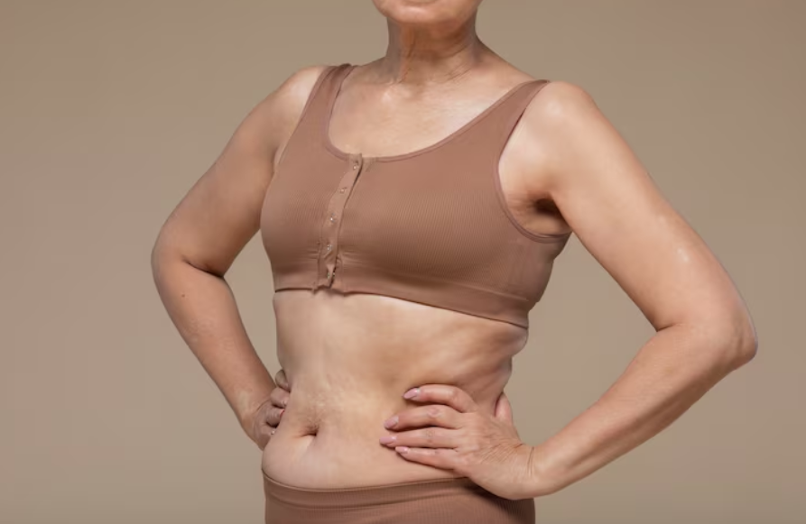Tummy Tuck Singapore: Different Techniques Explained