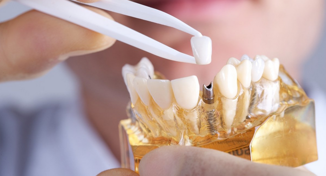 Ways to Pick the Best Clinic for Dental Implants