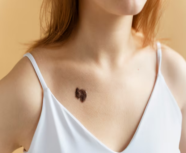 Keloid removal Malaysia treatments that help reduce thick scars