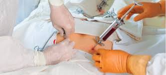 How Stem Cell Transplants Are Saving Lives: Real Medical Breakthroughs You Should Know