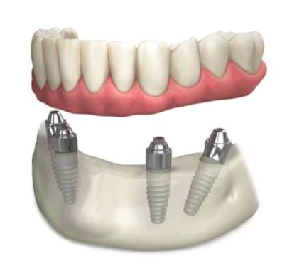 How to Choose the Best Teeth Replacement Melbourne Solution