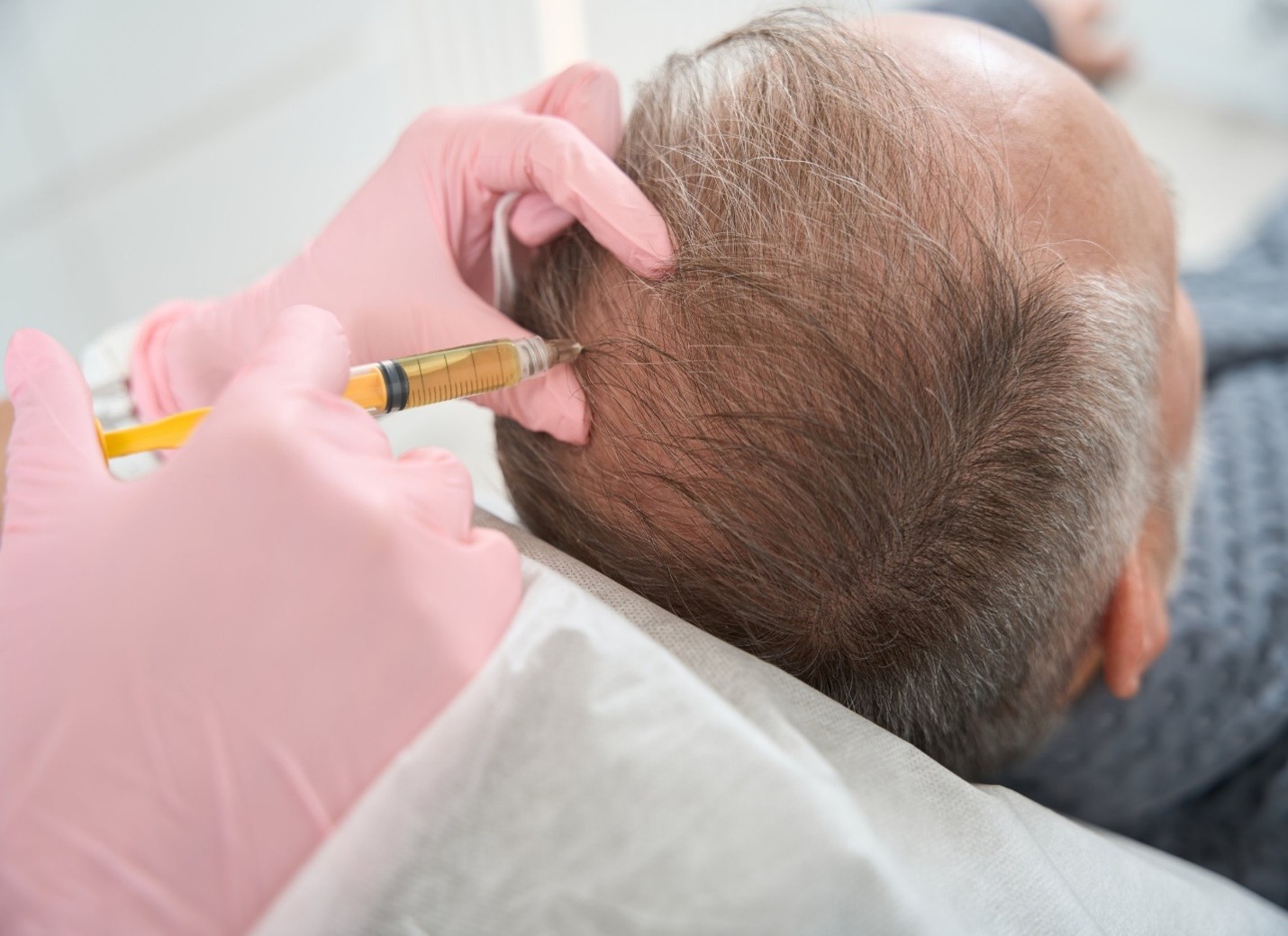 Hair loss treatment Apple Valley options can help restore your thinning scalp hairline