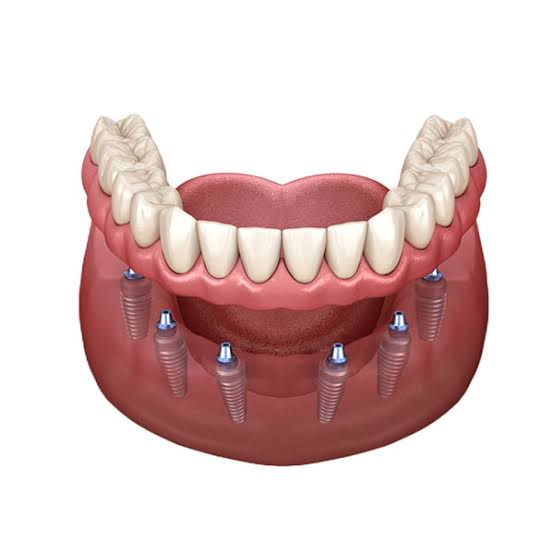 All-on-6 Dental Implants in Turkey, Antalya – 2026