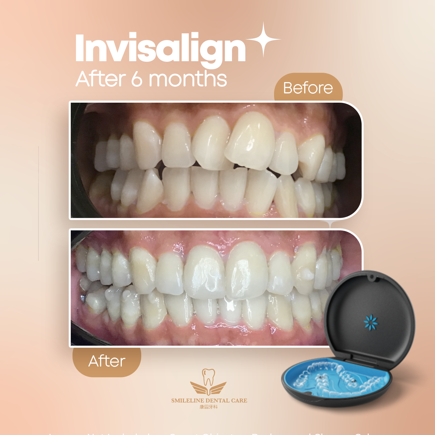 Clear Aligners for Busy Adults: How to Prepare for a Successful Treatment Journey