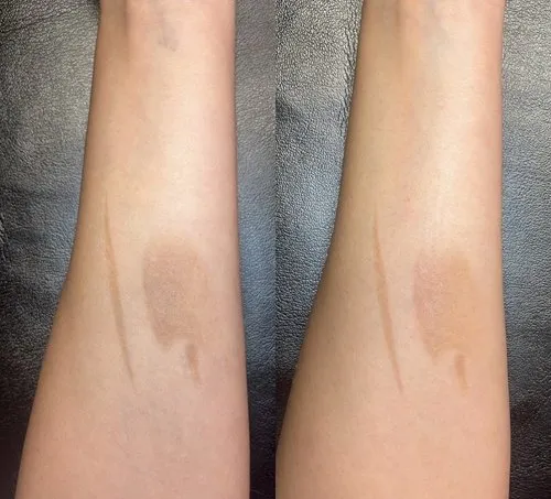Before and after of skin brigthening performed on an arm