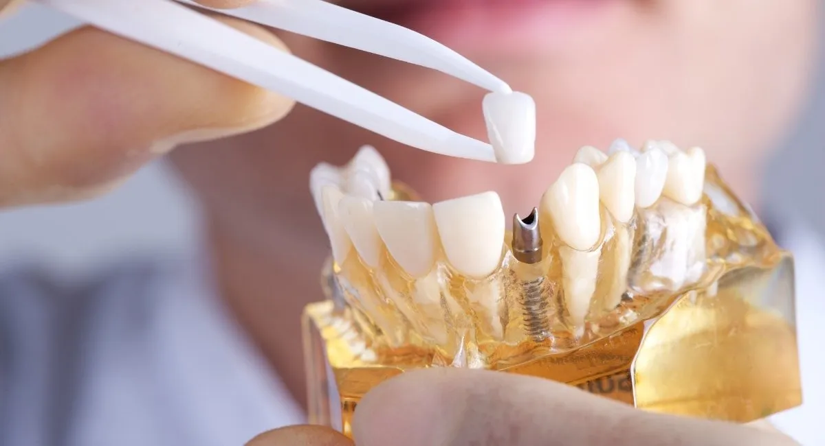 How Dental Implants and Teeth Replacement Provide Immediate Stability