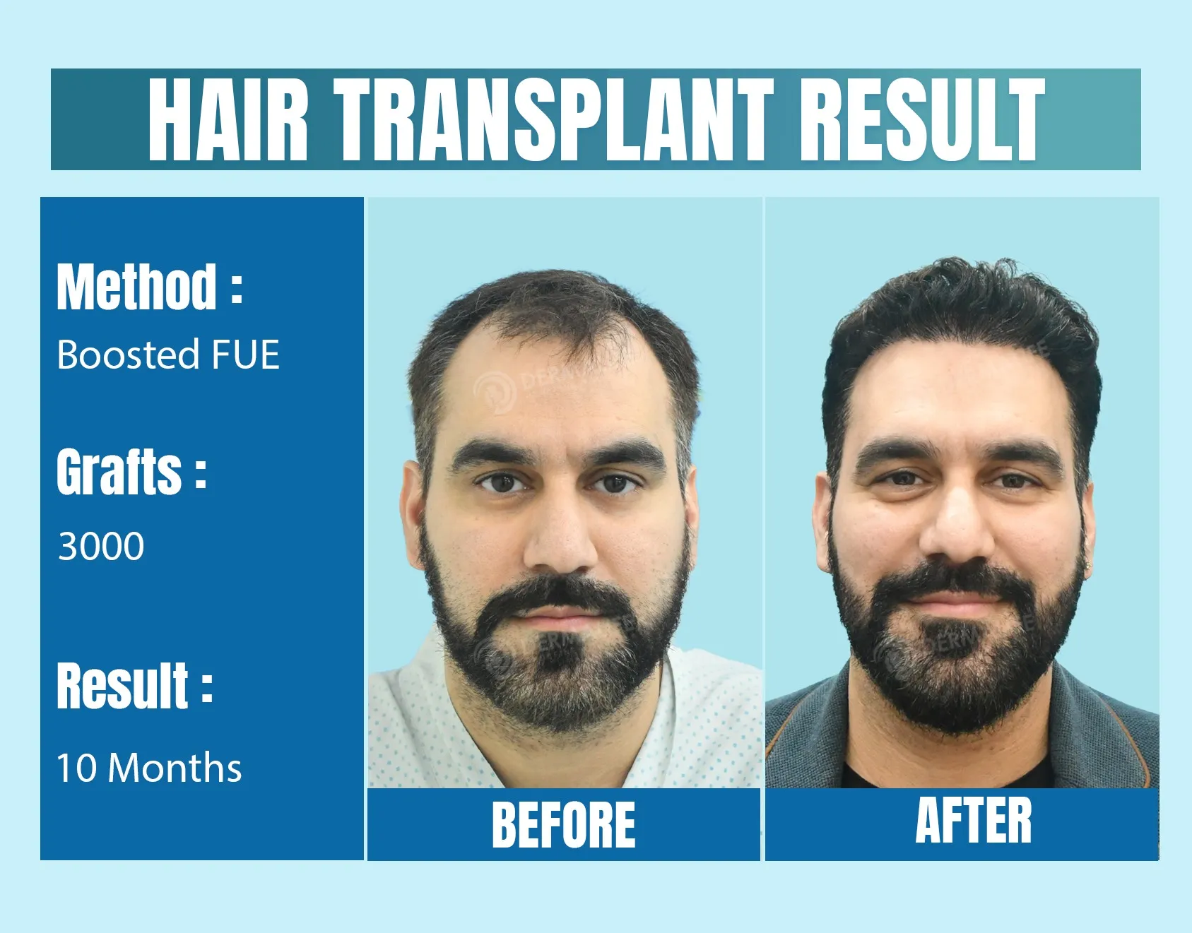 Trusted Hair Transplant Clinic in Delhi, India: How to Choose the Right Center Trusted Hair Transplant Clinic in Delhi, India: How to Choose the Right Center
